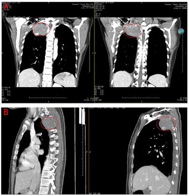 Sclerosing Epithelioid Fibrosarcoma of the Thoracic Vertebrae: An Fairly Unusual Case Report With a Short Review of Literature